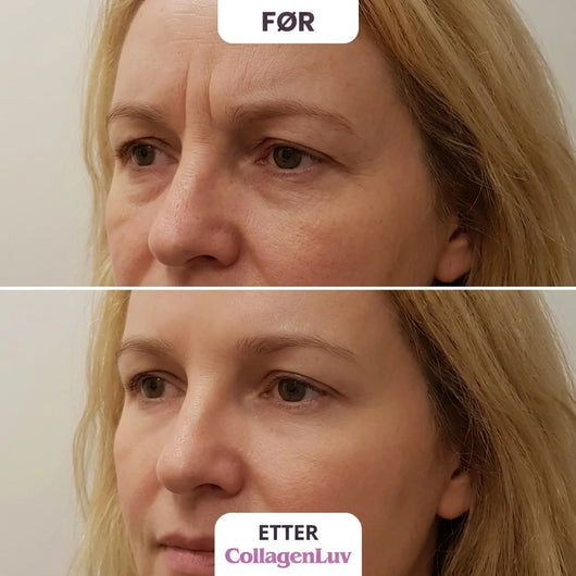CollagenLuv™ Kollagen Silikonplaster