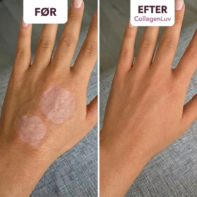 CollagenLuv™ Kollagen Silikoneplaster